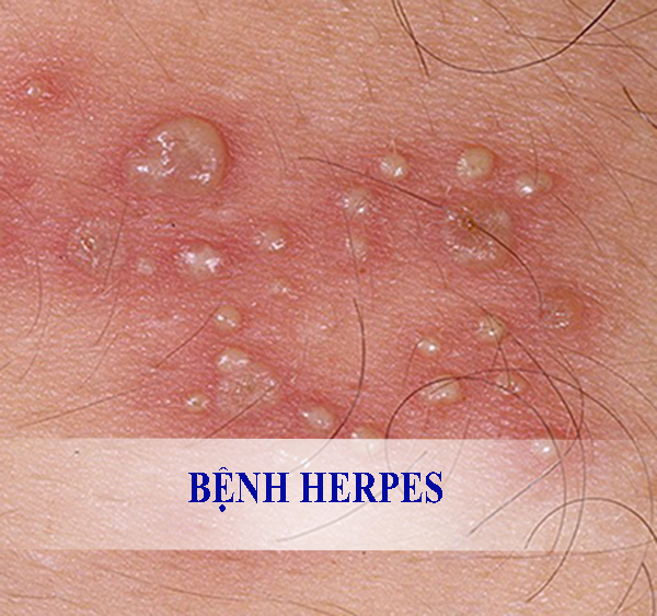 bệnh herpes và cách điều trị bệnh herpes