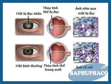 Sức khỏe đôi mắt: bệnh đục thủy tinh thể